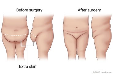 How To Get Rid of a Pannus Without Surgery? Practical Ways